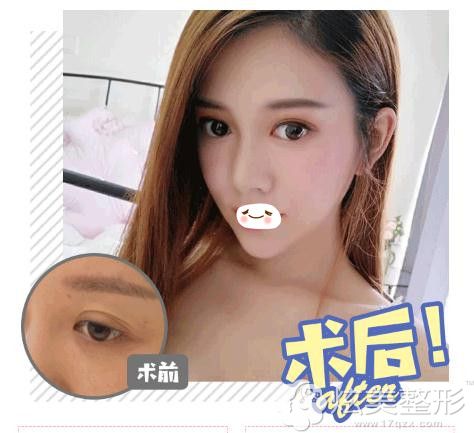 陈磊双眼皮整形真人案例 陈磊双眼皮整形真人案例