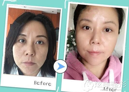 上海艺星医疗美容医院做热玛吉术后恢复案例 上海艺星医疗美容医院做热玛吉术后恢复案例