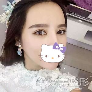 在福州台江整形做双眼皮和开眼角术后恢复效果 在福州台江整形做双眼皮和开眼角术后恢复效果
