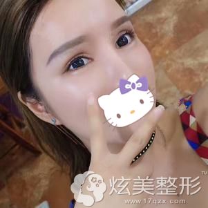 做切开双眼皮和开眼角术后30天眼睛疤痕渐消 做切开双眼皮和开眼角术后30天眼睛疤痕渐消