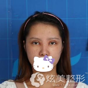 陈邦塘主任做双眼皮和开眼角术后7天拆线 陈邦塘主任做双眼皮和开眼角术后7天拆线