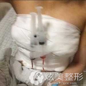 济南海峡做曼托假体丰胸手术当天 济南海峡做曼托假体丰胸手术当天