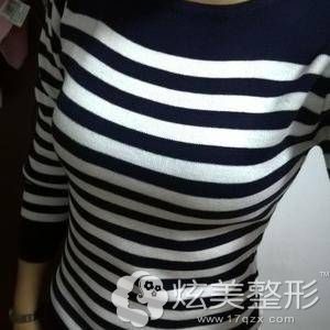 济南海峡做曼托假体丰胸术后十天 济南海峡做曼托假体丰胸术后十天