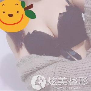 济南海峡做曼托假体丰胸术后一个月 济南海峡做曼托假体丰胸术后一个月