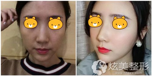深圳阳光整形美容医院光子嫩肤术后对比图 深圳阳光整形美容医院光子嫩肤术后对比图
