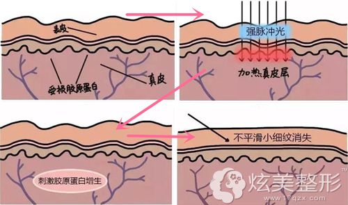 光子嫩肤除皱原理图 光子嫩肤除皱原理图