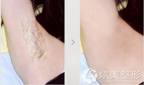 吉林瑞澳分享腋下脱毛案例 吉林瑞澳分享腋下脱毛案例