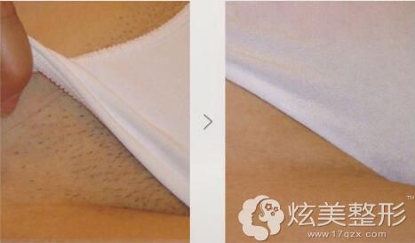 在吉林瑞澳做比基尼脱毛案例对比 在吉林瑞澳做比基尼脱毛案例对比