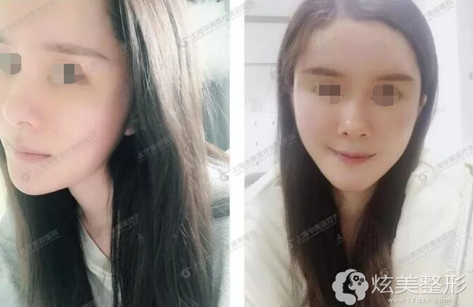 脂肪填充术后七天面部肿胀 脂肪填充术后七天面部肿胀