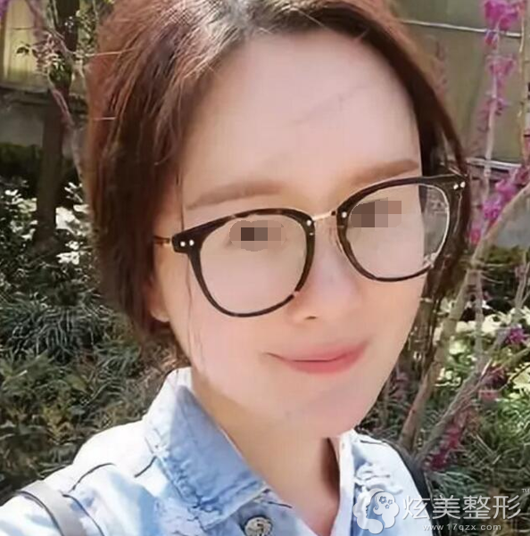 淤青和肿胀消退后的面部 淤青和肿胀消退后的面部
