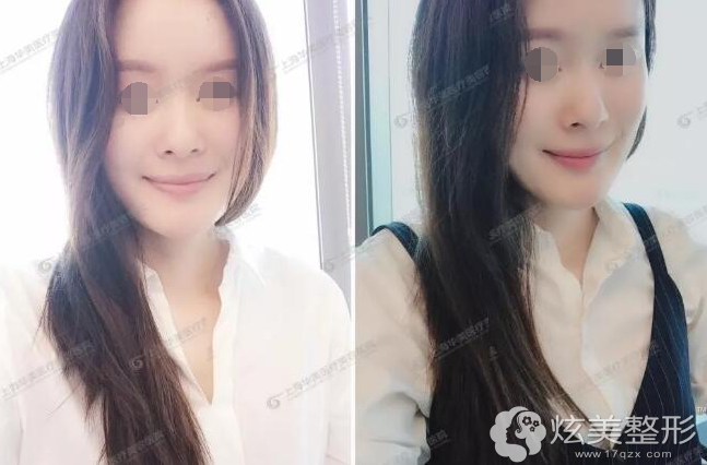自体脂肪全面部填充术后48天 自体脂肪全面部填充术后48天