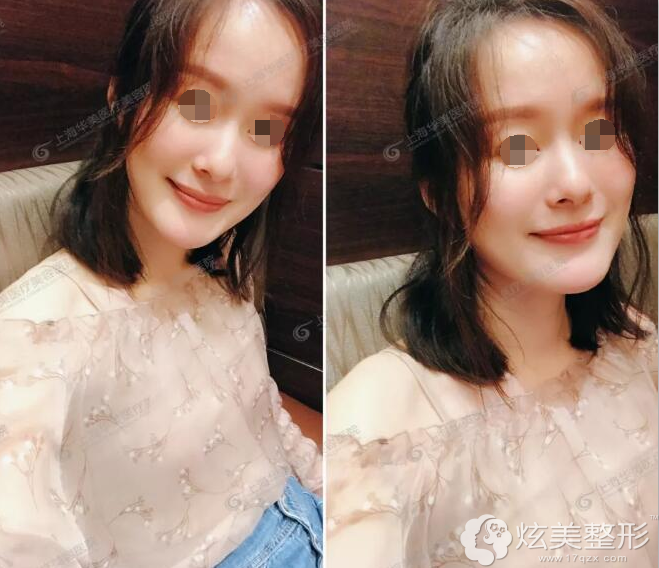 谢卫国院长自体脂肪面部填充术后70天 谢卫国院长自体脂肪面部填充术后70天