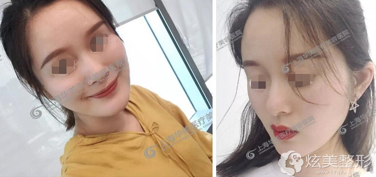 上海华美自体脂肪全面部填充案例 上海华美自体脂肪全面部填充案例