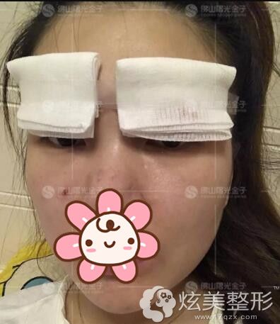 刚做完眼综合整形术后恢复 刚做完眼综合整形术后恢复