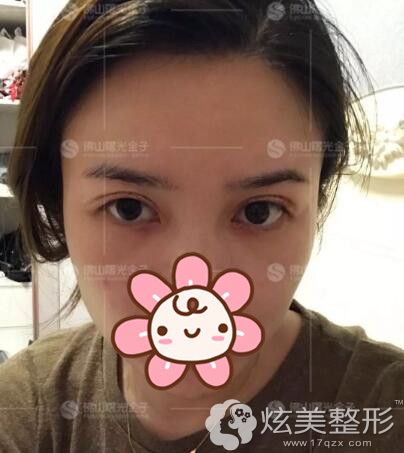 一周拆线佛山曙光金子分享眼部恢复情况 一周拆线佛山曙光金子分享眼部恢复情况