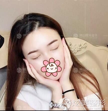 术后25天双眼皮恢复闭眼痕迹淡化 术后25天双眼皮恢复闭眼痕迹淡化