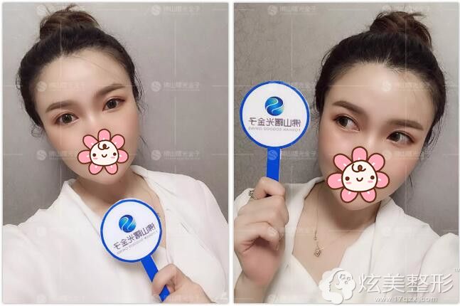 到佛山曙光金子做眼综合术后恢复 到佛山曙光金子做眼综合术后恢复