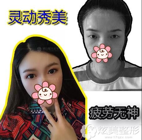 佛山曙光金子眼综合术前术后对比案例 佛山曙光金子眼综合术前术后对比案例