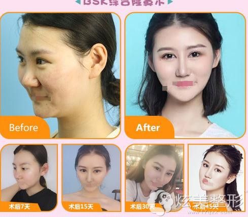 北京艺星整形鼻综合整形案例 北京艺星整形鼻综合整形案例