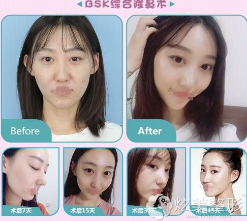 北京艺星整形鼻综合 北京艺星整形鼻综合