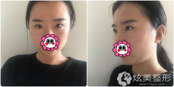 面诊韩兴斌院长术前单眼皮 面诊韩兴斌院长术前单眼皮