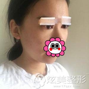 到绍兴维美做完眼综合术后即刻恢复 到绍兴维美做完眼综合术后即刻恢复