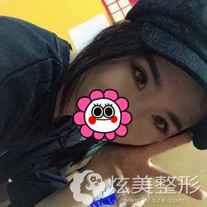 术后十天拆线后眼综合恢复 术后十天拆线后眼综合恢复