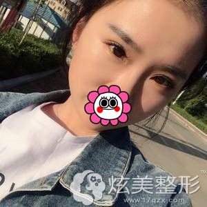 术后20天眼综合恢复样子 术后20天眼综合恢复样子