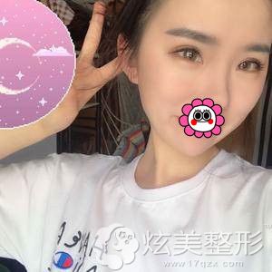 到绍兴维美做眼综合术后恢复效果 到绍兴维美做眼综合术后恢复效果