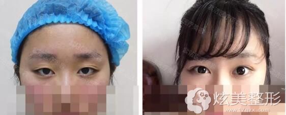 张学艳医生双眼皮案例对比 张学艳医生双眼皮案例对比