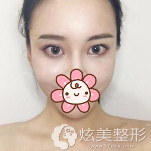 在南京江宁亚韩医学美容医院做激光去眼袋术后效果 在南京江宁亚韩医学美容医院做激光去眼袋术后效果