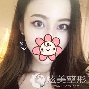 赵新房主任做做激光去眼袋术后30天手术疤痕消失 赵新房主任做做激光去眼袋术后30天手术疤痕消失