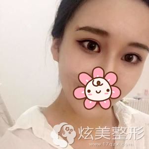 做激光去眼袋术后15天眼部没有出现肿胀感 做激光去眼袋术后15天眼部没有出现肿胀感