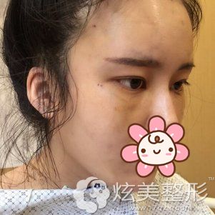 赵新房主任做激光去眼袋术后3天效果 赵新房主任做激光去眼袋术后3天效果