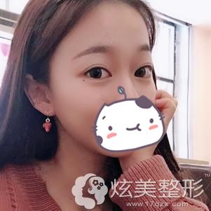 在南昌爱思特整形做自体脂肪丰额头术后90天恢复效果 在南昌爱思特整形做自体脂肪丰额头术后90天恢复效果