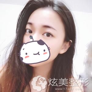 胡院长做自体脂肪丰额头术后30天额头饱满双眼皮自然 胡院长做自体脂肪丰额头术后30天额头饱满双眼皮自然