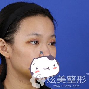 做自体脂肪丰额头术后7天肿胀消除 做自体脂肪丰额头术后7天肿胀消除