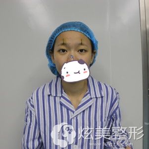 胡秀龙院长做自体脂肪丰额头术前画线设计 胡秀龙院长做自体脂肪丰额头术前画线设计