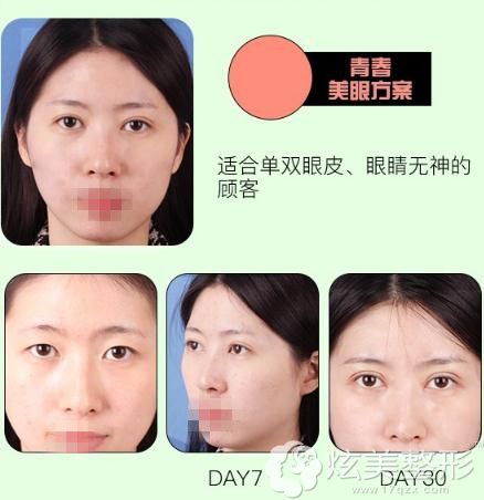 李鹏医生眼综合整形案例 李鹏医生眼综合整形案例