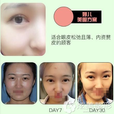 李鹏医生眼综合整形案例 李鹏医生眼综合整形案例
