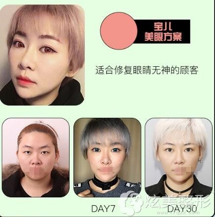 李刚医生眼综合整形案例 李刚医生眼综合整形案例