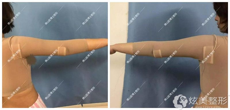 吸脂后穿着塑身衣的手臂 吸脂后穿着塑身衣的手臂