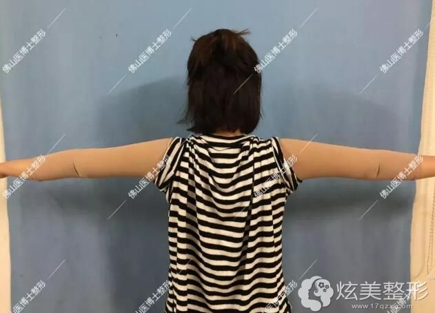 做完吸脂瘦手臂术后8天逐渐消肿 做完吸脂瘦手臂术后8天逐渐消肿