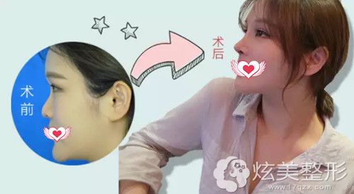 金辉院长做鼻综合整形案例 金辉院长做鼻综合整形案例