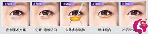 卫康整形外切去眼袋手术原理图 卫康整形外切去眼袋手术原理图