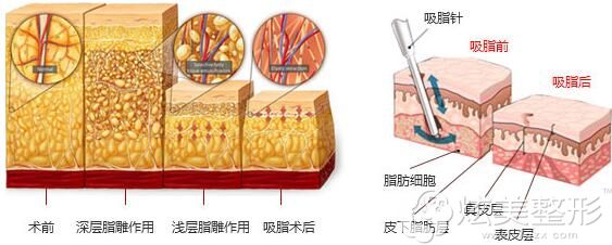 南京华美整形分层吸脂紧肤原理图 南京华美整形分层吸脂紧肤原理图
