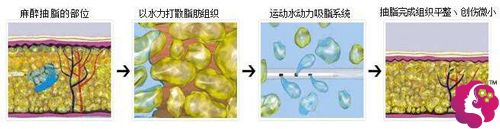 苏州康华水动力抽脂手术原理 苏州康华水动力抽脂手术原理