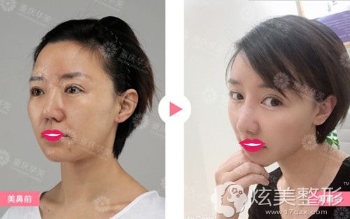重庆华美医生张国强做自体软骨隆鼻失败修复案例 重庆华美医生张国强做自体软骨隆鼻失败修复案例