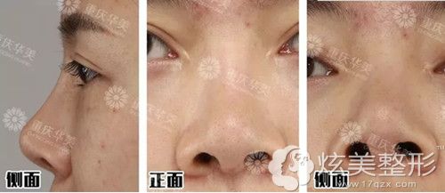 在重庆华美做鼻修复术前鼻假体轮廓明显、鼻孔外露 在重庆华美做鼻修复术前鼻假体轮廓明显、鼻孔外露