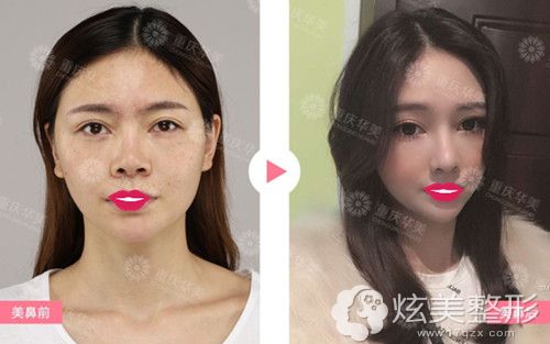 华美整形李任博士做半肋软骨鼻综合整形修复案例 华美整形李任博士做半肋软骨鼻综合整形修复案例